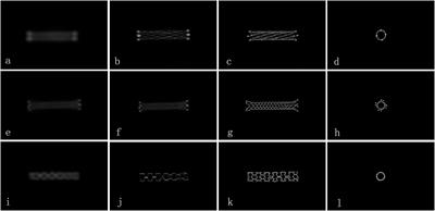 Application of High-Resolution Flat Detector Computed Tomography in Stent Implantation for Intracranial Atherosclerotic Stenosis